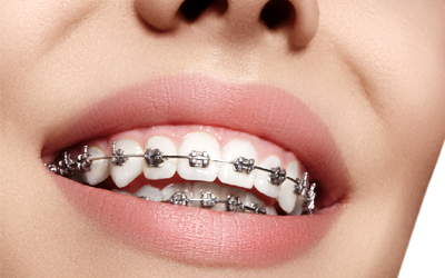 Quy trình niềng răng thẩm mỹ tại HD Dental