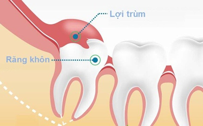Viêm lợi trùm biểu hiện ra sao?