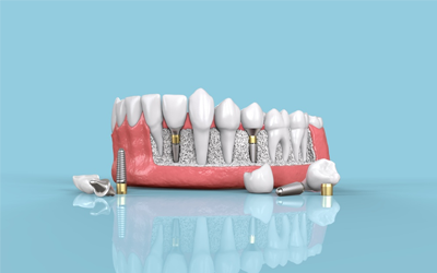 TRỒNG RĂNG IMPLANT - ÁP DỤNG KHI NÀO???