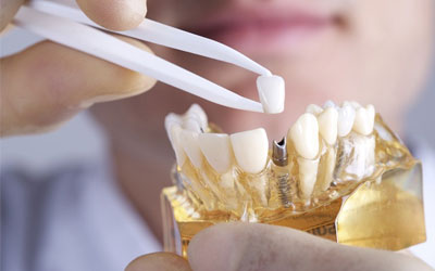 Cấy ghép IMPLANT mất bao lâu?