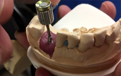 IMPLANT NEODENT: Tích hợp vượt trội – Thách thức thời gian