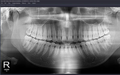 Bạn nhổ răng khôn ở đâu?