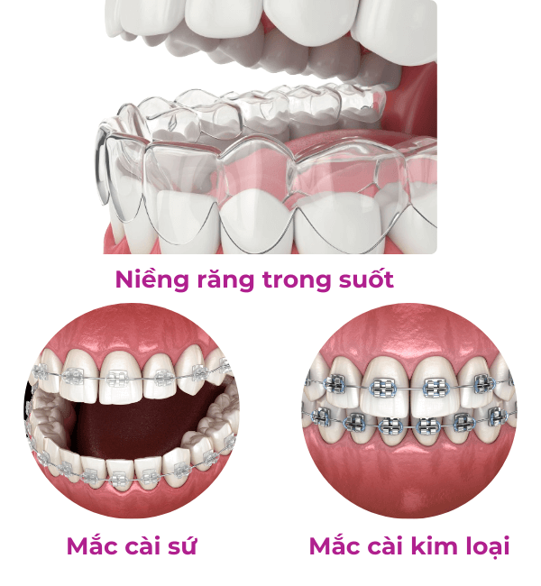 Niềng răng Kinh Môn