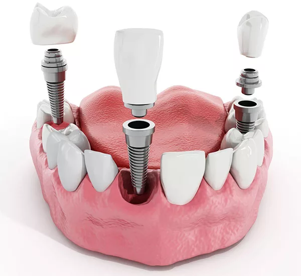 Trồng răng giả Kinh Môn