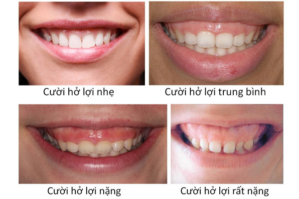 Điều trị cười hở lợi tại Kim Môn